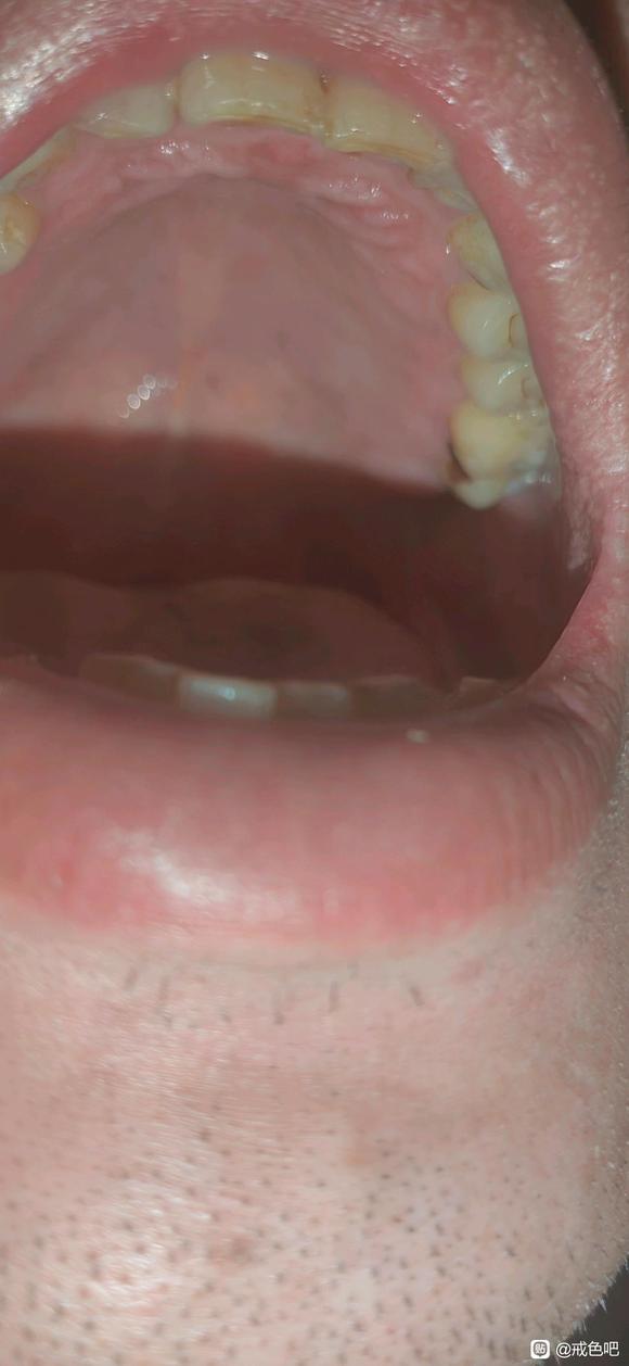 ”最近咽炎难受的吃中药都没有效果虚火大的牙龈红肿
