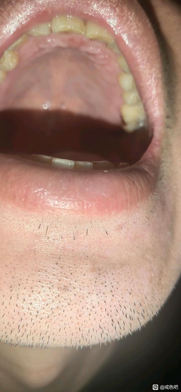 ”最近咽炎难受的吃中药都没有效果虚火大的牙龈红肿