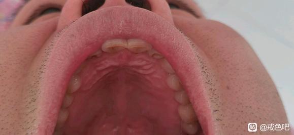 ”老哥们戒下去咽炎会恢复吗有没有戒了咽炎恢复得案例呀