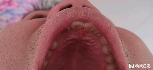 ”老哥们戒下去咽炎会恢复吗有没有戒了咽炎恢复得案例呀