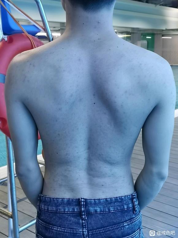 ”有没有做过激光去痘印的戒友？