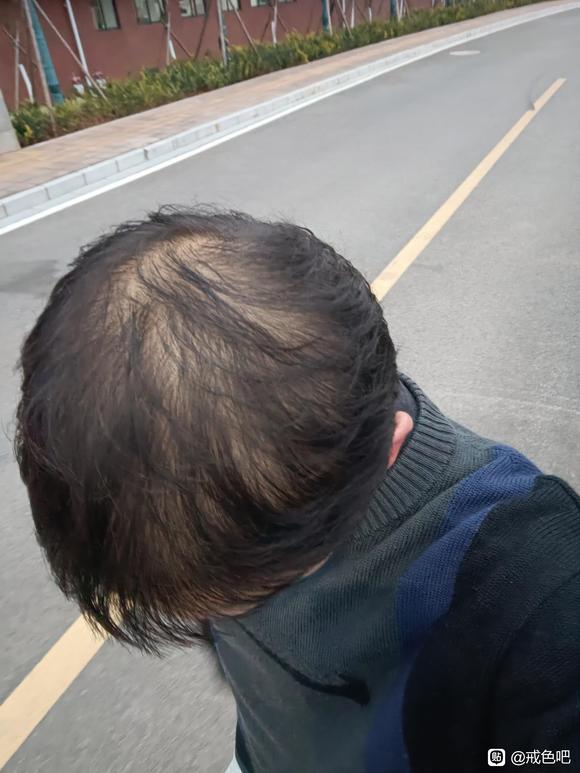 ”sy+一点点遗传的雄脱并且严重脱发还能恢复吗