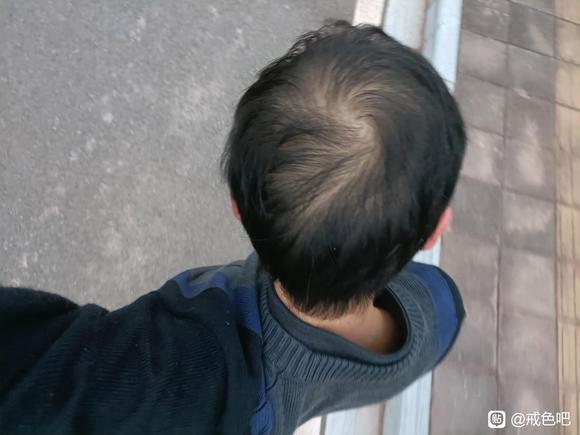 ”sy+一点点遗传的雄脱并且严重脱发还能恢复吗