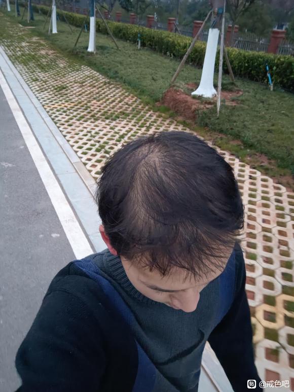 ”sy+一点点遗传的雄脱并且严重脱发还能恢复吗