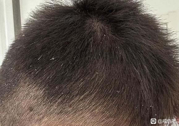 ”长期遗精须发早白