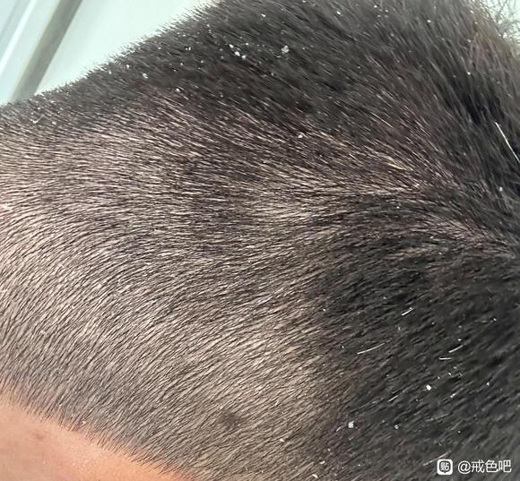 ”长期遗精须发早白