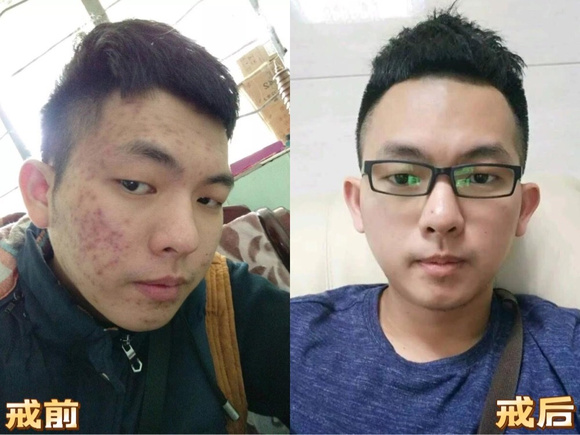 ”戒色一年，痘痘终于恢复了